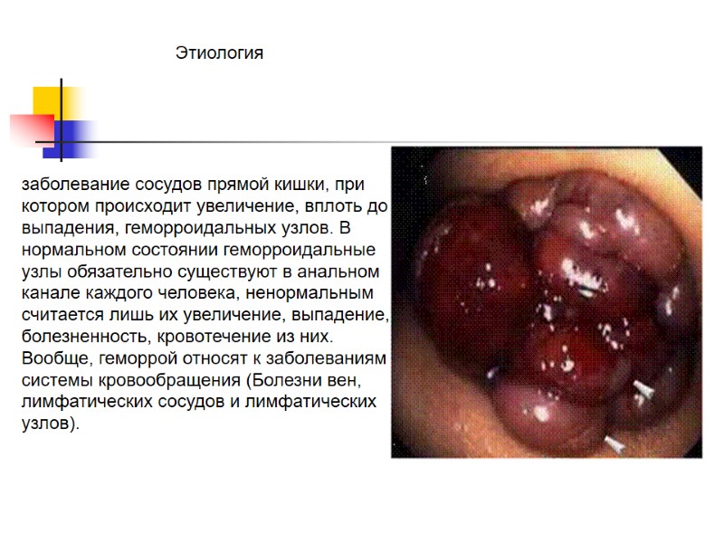 Этиология заболевание сосудов прямой кишки, при котором происходит увеличение, вплоть до выпадения, геморроидальных узлов.